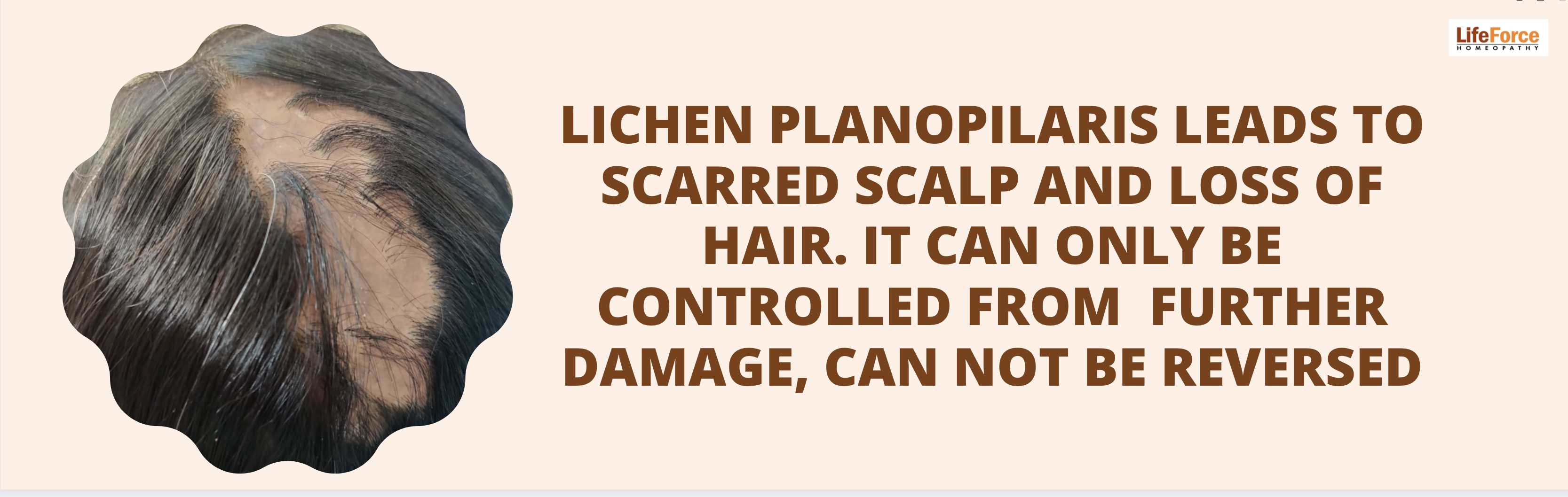 Lichen Planopilaris